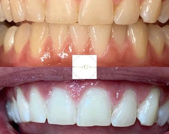 16% waterstofperoxide (extra sterkte). Gelset van 3 bleekpennen van tandheelkundige kwaliteit met LED-acceleratorlicht. Tot (8) tinten witter.