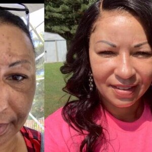 May include: Before and after photographs of a person's face. The first photograph shows dark spots on the skin. The second photograph shows clear skin.