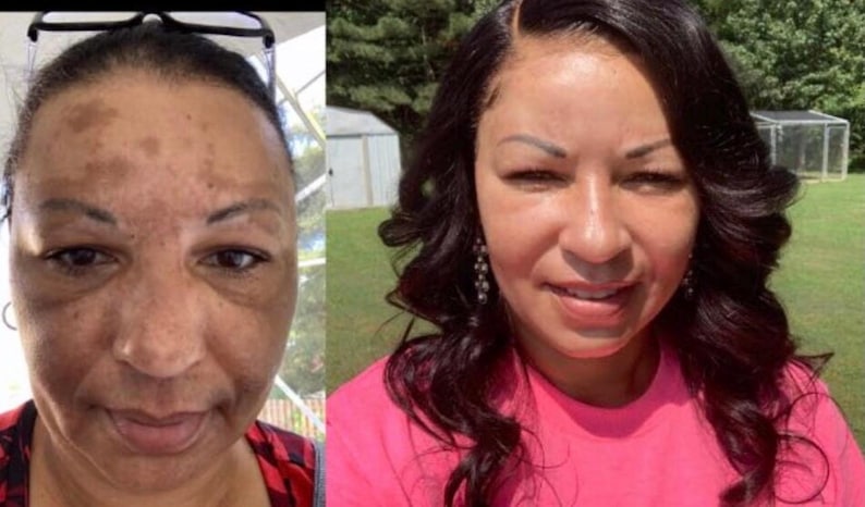 May include: Before and after photographs of a person's face. The first photograph shows dark spots on the skin. The second photograph shows clear skin.