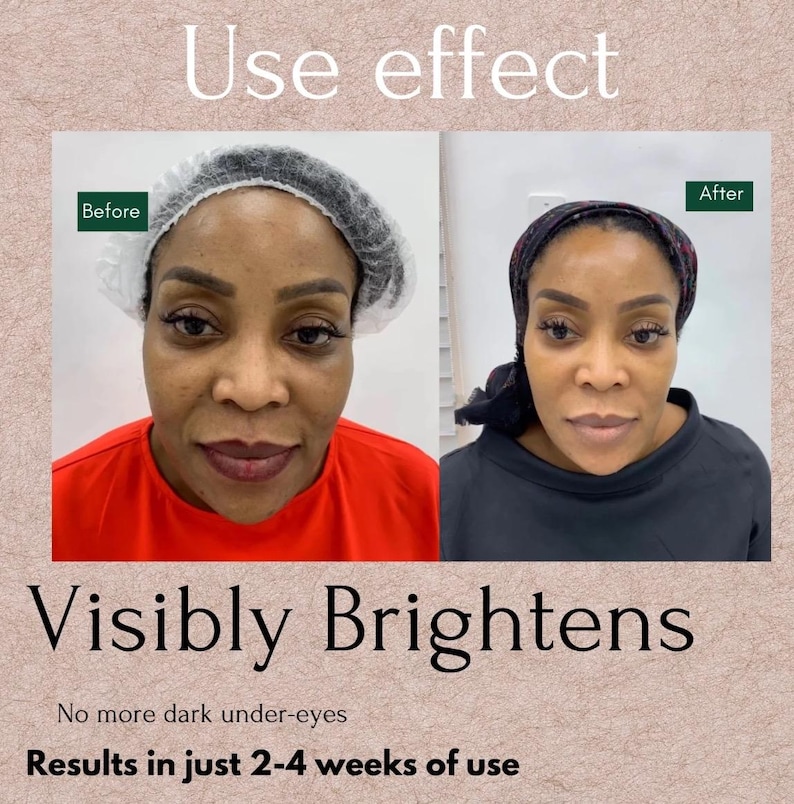 May include: Before and after photos showing the results of using a product that visibly brightens skin. The text "Use effect" is at the top of the image. The text "Visibly Brightens" is below the photos. The text "No more dark under-eyes" is below the text "Visibly Brightens". The text "Results in just 2-4 weeks of use" is at the bottom of the image.