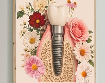 Dental Implant Art, Dentist Office Decor, Dental Implant Poster, Implant Dentistry Wall Art, Periodontist Decor, Dental Clinic Decor