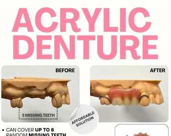 Acrylic Partial Dentures for Missing Teeth. Custom Dental Solution. Free Shipping. Free Impression Kit Included.