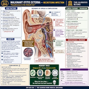 Könnte beinhalten: Eine medizinische Lehrgrafik mit dem Titel Malignant Otitis Externa, die einen detaillierten anatomischen Querschnitt des menschlichen Ohrs sowie Textfelder zu Risikofaktoren, klinischen Merkmalen, Ausbreitungswegen und Behandlungen zeigt.