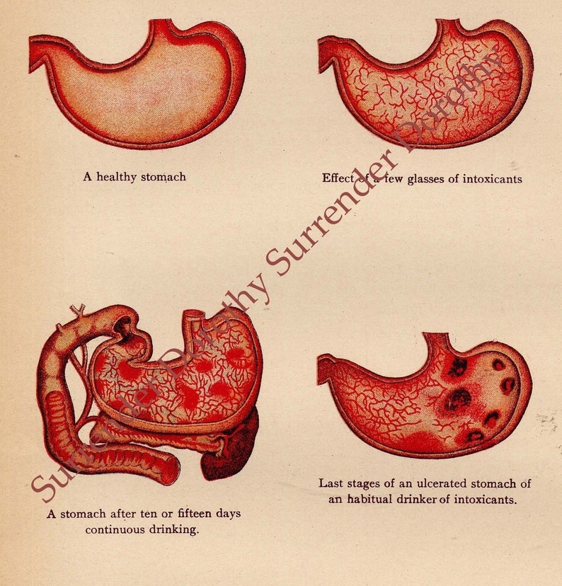 Effects Of Alcohol On The Stomach 1908 Antique Human Anatomy Etsy
