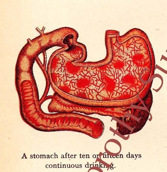 Abdominal Anatomy Alcoholic