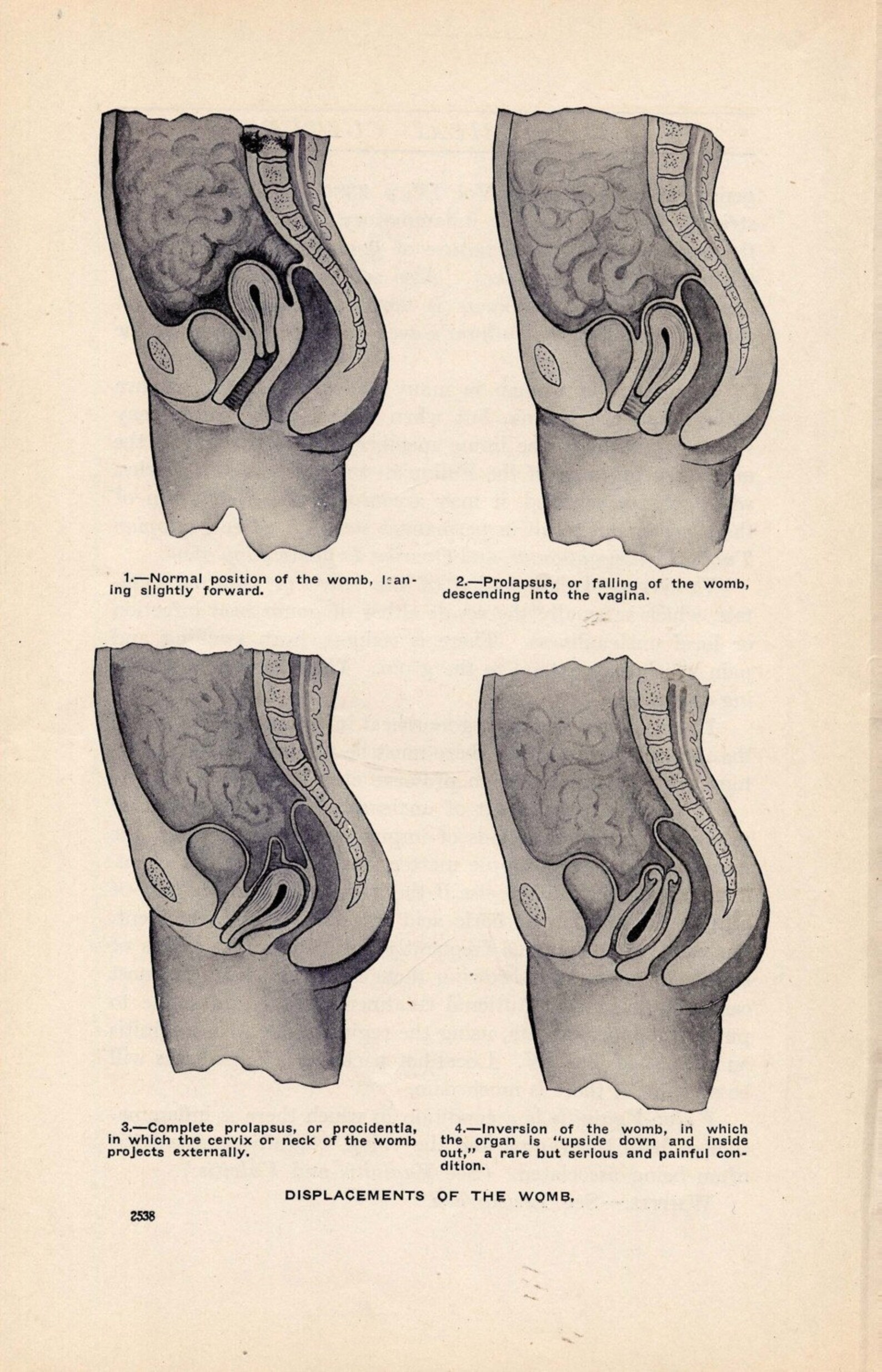 Female Anatomy Womb Displacement Chart 1906 Edwardian Era | Etsy