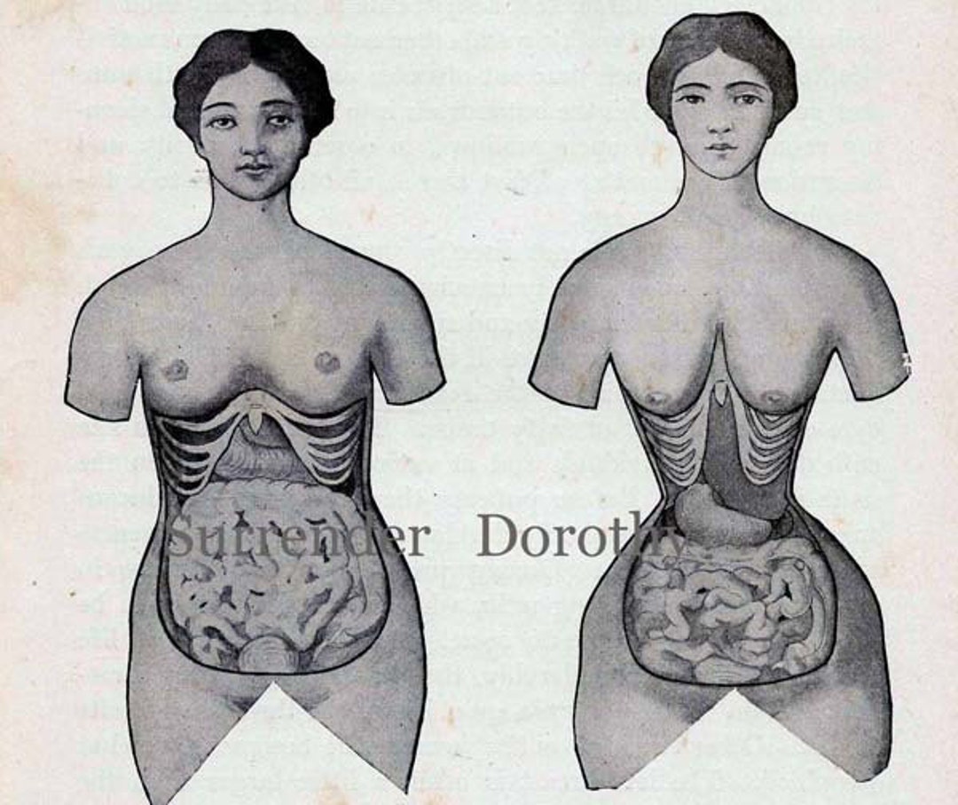 Corset Disfigurement Human Female Anatomy Vintage Medical Chart 1920s  Illustration to Frame Black & White 