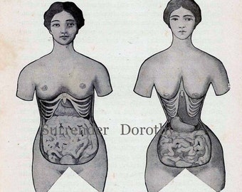 Corset Disfigurement Human Female Anatomy Vintage Medical Chart 1920s Illustration To Frame Black & White
