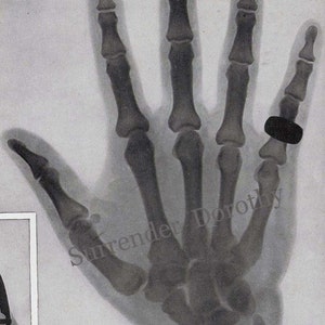 May include: Black and white x-ray image of a hand with a ring on the ring finger.