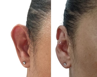 Discreet ear corrector