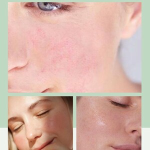 May include: A collage of three facial images showing skin texture, with the text Peau Sensible and Comprendre et prendre soin de votre peau délicate printed in dark green on a light green background, focusing on facial skin appearance.