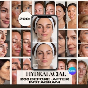 200+ Hydrafacial Instagram Templates — 200+ Before After Canva | Medspa Esthetician Posts Stories | Skin Transformation | Glow Skin Results