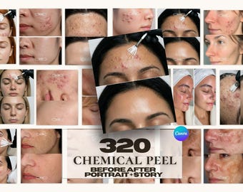 320 Chemical Peel Instagram Templates | Before After Skin Post | Esthetician Medspa Canva | Clinic Social Media