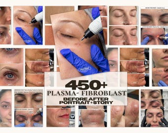 450 Plasma pen Fibroblast Before & After Instagram Templates | Portrait + Story Canva | Non-Surgical Skin Tightening Fibroblast Medspa