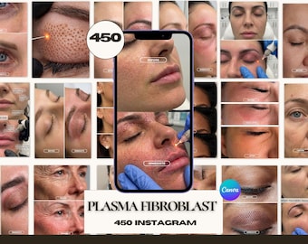 Plasma pen Fibroblast Before & After Instagram Templates | Plasma Pen Fibroblast Skin Tightening Canva Post | Non-Surgical Facelift Medspa