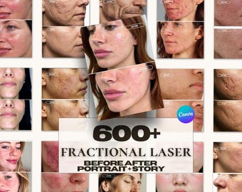 Fractional Laser Instagram Templates — 600 Canva Posts & Stories | Before After Skin Resurfacing | Medspa Esthetician| aesthetic clinic