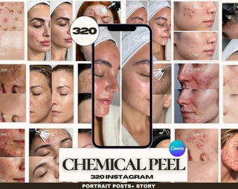 320 Chemical Peel Instagram Templates | Before After Skin Post | Esthetician Medspa Canva | Clinic Social Media