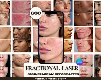 Fractional Laser Instagram Templates — 600 Canva Posts & Stories | Before After Skin Resurfacing | Medspa Esthetician- Medspa Aesthetic