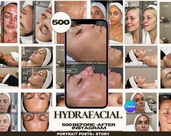 500 Hydrafacial Instagram Templates — Before After Canva | Medspa Esthetician Posts stories| Skin Transformation | Glow Skin Results.