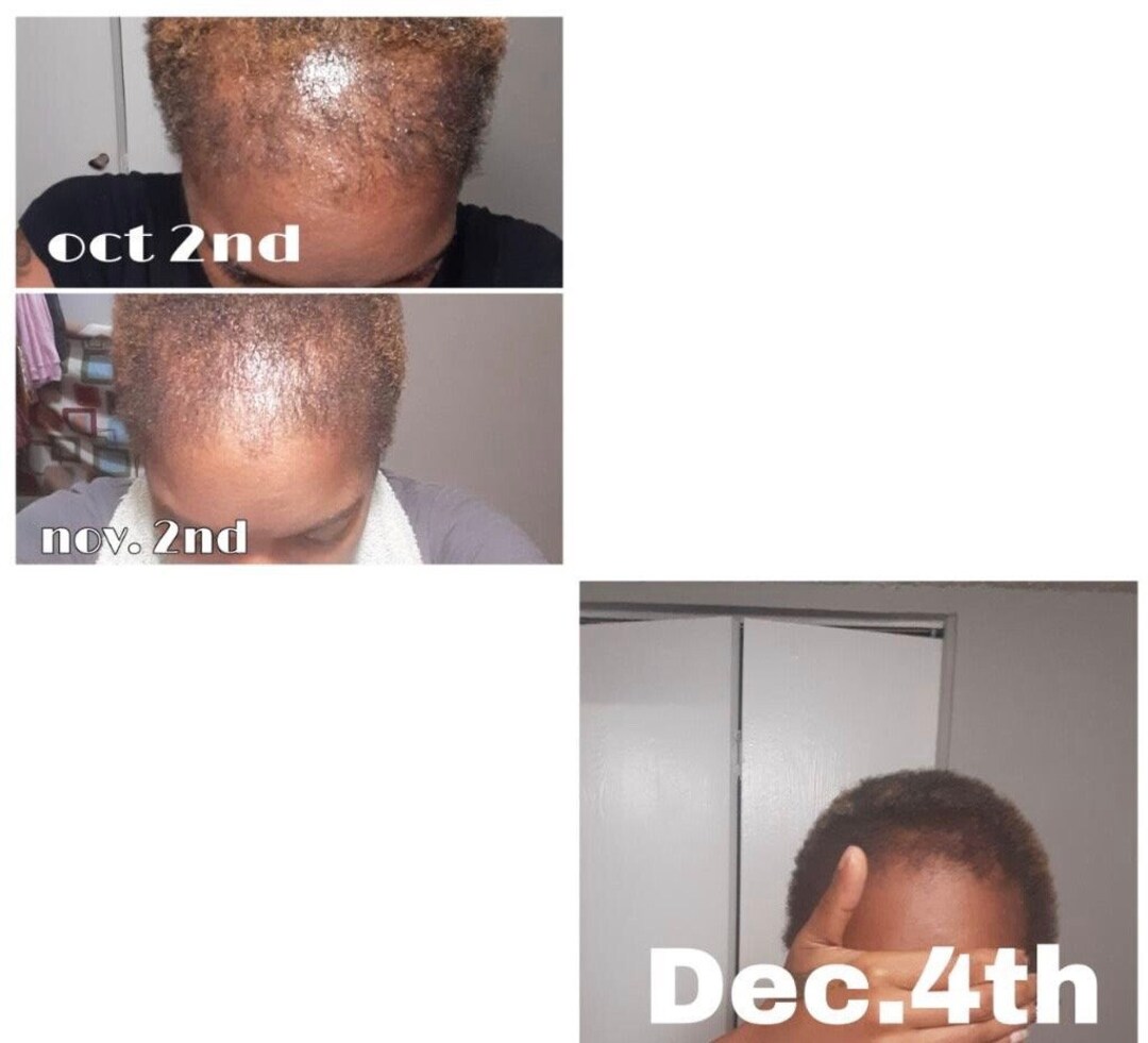 Bald Head Hoe Shit Hair Growth Kit - Etsy