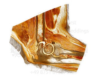 Canine elbow with exostosis and bone deformation due to chronic arthrosis of the elbow joint - scientific image print