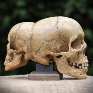Parasitenzwillingsschädel-Replik: Echter menschlicher Schädel. Medizinische Kuriosität.