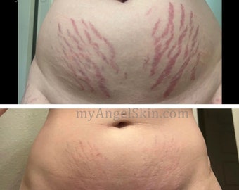 Fade fresh purple stretch marks with Premium STRETCH MARK OIL made of 15 Organic Oils skin-bioidentical safe fore pregnancy stretch marks