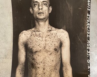 WARNING: Nudity - Antique Medical Photographs - Set of 4 - Skin Diseases - Dermatology - Deformity Photos