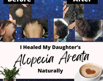 Cómo curé la alopecia areata de mi hija de forma natural E-book con enlaces en directo; Guía práctica para el crecimiento del cabello por alopecia areata a partir de mi experiencia