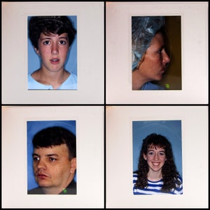 May include: A composite image of four medical slides. The slides feature close-up portraits of individuals, likely patients. The images show different angles of the faces, possibly for medical documentation or analysis. The backgrounds are a solid blue.