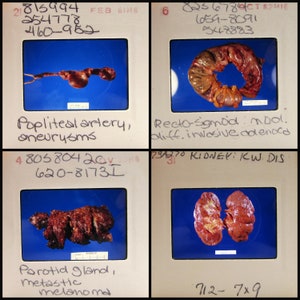 25 Internal Organs vintage photo slides - Human Anatomy - vintage 35mm slides - medical oddities - gory - tumors