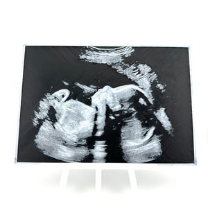 Custom 3d Printed Ultrasound