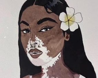 Vitiligo portrait
