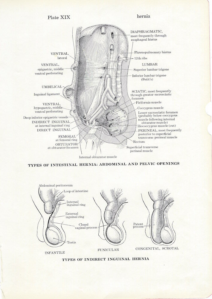 Human Anatomy Hernias Vintage Medical Anatomy Illustration to Frame or for Collage, Scrapbooking and Paper Arts PSS 3239