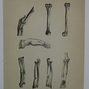Antique Book Plate Medical Book Turn of the Century Medicine Curiosity 1900 Bone Fracture