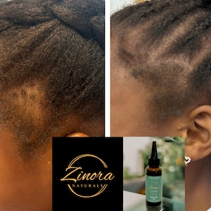 May include: Before and after photos showing the results of using a hair growth oil. The before photo shows a person with thinning hair on the top of their head. The after photo shows the same person with thicker hair. The hair growth oil bottle is labeled "Zinora Naturals".