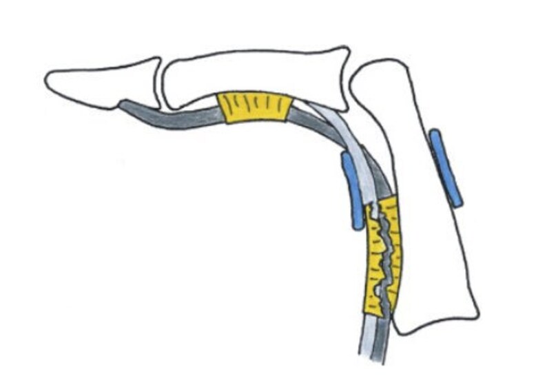Custom A2 Pulley Protection Splint Climbing Recovery Pulley Ring Sized