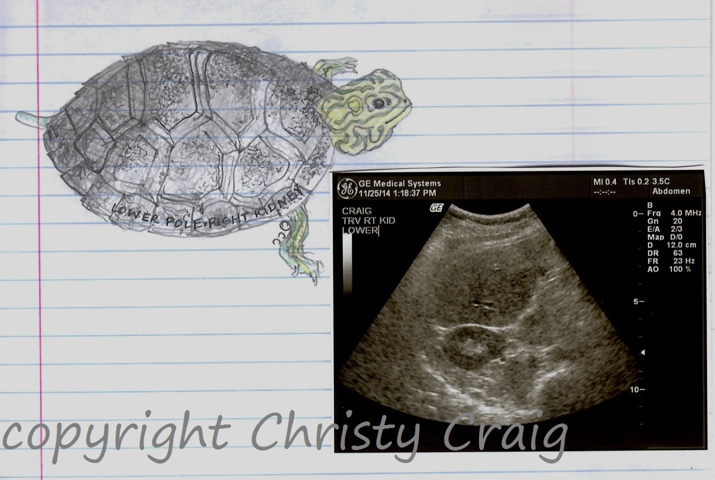 Turtle Sign Ultrasound