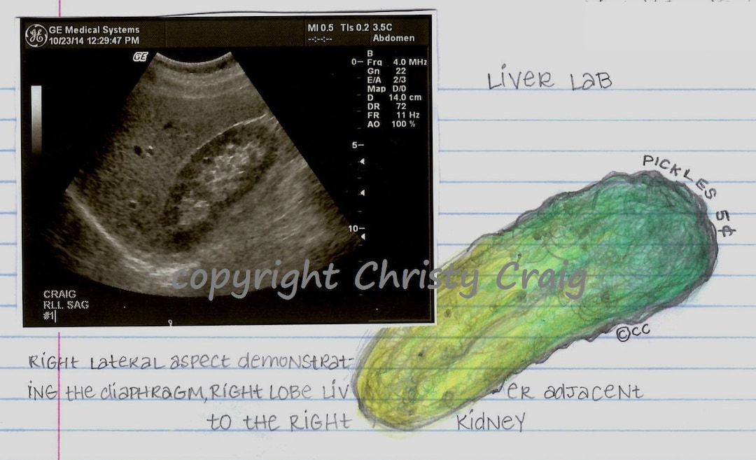 Pickle Kidney Print Etsy