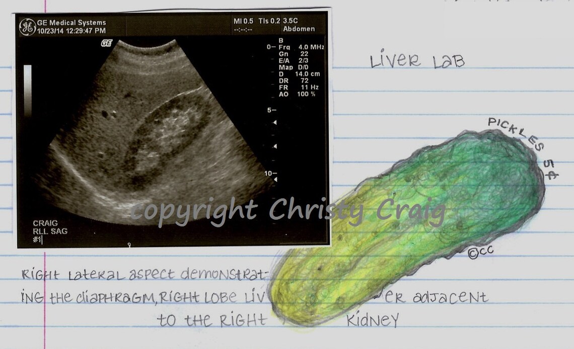 Pickle Kidney Print Etsy