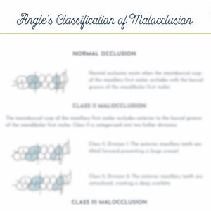 May include: A diagram illustrating Angle's classification of malocclusion. The diagram shows three different types of occlusion: normal occlusion, Class I malocclusion, and Class II malocclusion. Each type of occlusion is represented by a drawing of teeth in a side view.
