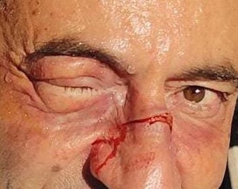 May include: A close-up of a man's face with a red mark on his nose and under his eye. The man is smiling and has dark hair.