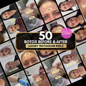 50 botox Instagram-rullar, botox- och fillerrullar, botox-canva-mall, sjuksköterskeinjektorrullar Medspa-rullmallar, botox före och efter