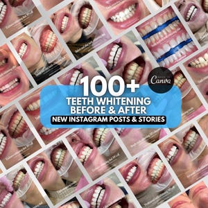 Puede incluir: Un collage de imágenes que muestran resultados de blanqueamiento dental. La imagen central presenta el texto "100+ TEETH WHITENING BEFORE & AFTER NEW INSTAGRAM POSTS & STORIES." Las imágenes circundantes muestran dientes antes y después del tratamiento.