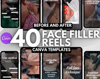 40 filler video instagram reels, botox and filler reels, face filler injection reels canva template, nurse injector instagram reels