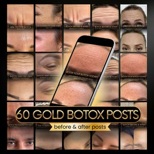 60 Botox Instagram-inlägg | Botox före och efter | Hudvård | Botox-canva | Anti-rynkor-inlägg, filler, gold med spa, estetisk sjuksköterska