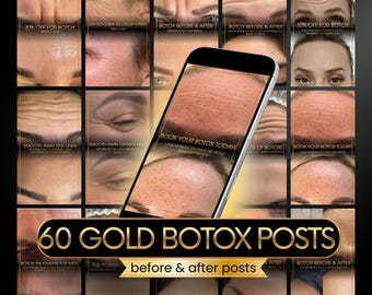 60 Botox Instagram posts | Botox before and after | Skincare | Botox canva | Anti wrinkle posts, filler, gold med spa, aesthetics nurse