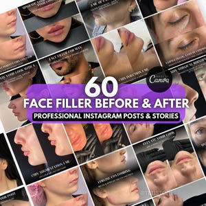 Może przedstawiać: Kolaż 60 zdjęć przed i po, pokazujący efekty wypełniaczy do twarzy. Zdjęcia są ułożone w siatkę i przedstawiają różne obszary twarzy, w tym usta, brodę i linię żuchwy. Tekst "60 FACE FILLER BEFORE & AFTER" jest wyświetlany dużą, pogrubioną czcionką u góry kolażu. Tekst "PROFESSIONAL INSTAGRAM POSTS & STORIES" jest wyświetlany mniejszą czcionką pod głównym tytułem.