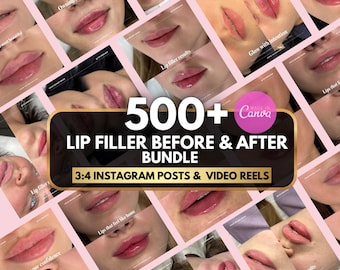 500 Lip filler before and after Instagram posts | Lip injection reels | Skincare | Lip filler canva template, Med spa, nurse injector video