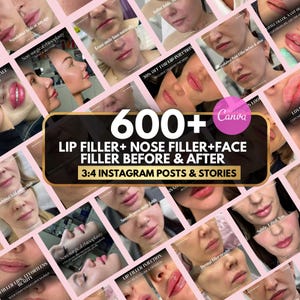 May include: A collage of images showcasing before and after results of lip, nose, and face filler procedures. The central graphic reads "600+ LIP FILLER + NOSE FILLER + FACE FILLER BEFORE & AFTER 3:4 INSTAGRAM POSTS & STORIES."